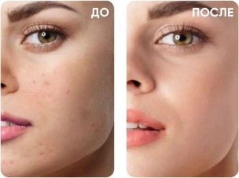 АКЦИЯ НА ВЕСЕННИЙ КОМПЛЕКС УХОДОВЫХ ПРОЦЕДУР