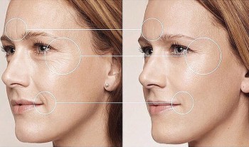 FULL FACE - Омолодить всё лицо на 10 лет за одну процедуру?