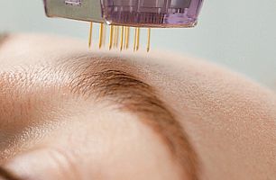 Теперь и в нашем салоне - МИКРОИГОЛЬЧАТЫЙ RF-ЛИФТИНГ